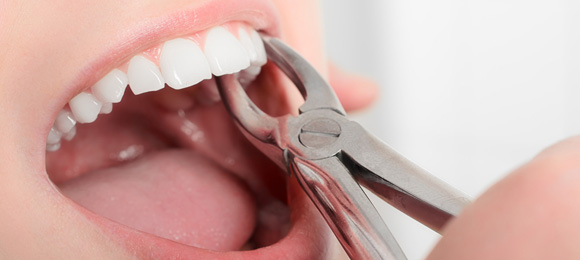 dentist-extracting-teeth dentist-extracting-teeth